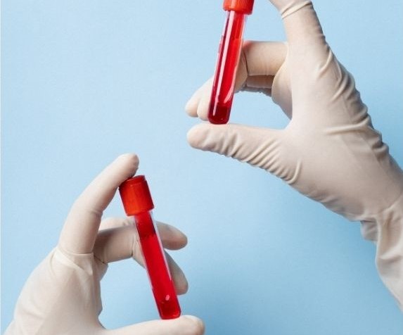 Vírus da Imunodeficiência Humana (HIV): Se não há um tratamento que leve à cura, então como existem alguns pacientes considerados&nbsp;curados?